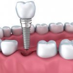 Причины болезненных ощущений после имплантации зубов