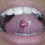 Causes and treatment of cysts under the tongue