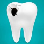 причины перфорации зуба