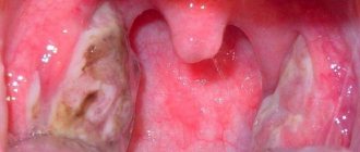 Causes of ulcers on the tonsils