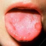 Причины стоматита на языке и способы его лечения
