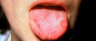 Причины стоматита на языке и способы его лечения