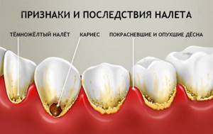 Признаки и последствия зубного камня