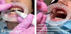 профессиональная чистка зубов