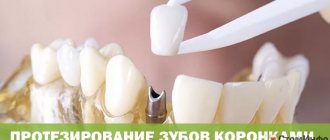 Протезирование зубов коронками