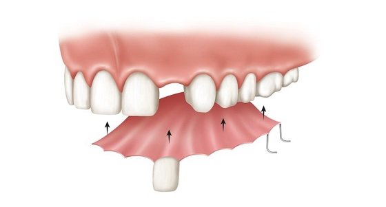протезы для верхних зубов