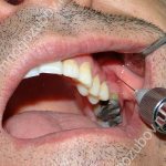 проведение инвильтрационной анестезии