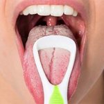 checking for candidiasis