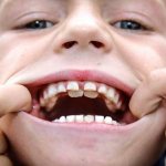 Пустой зуб у ребенка — что делать маме?