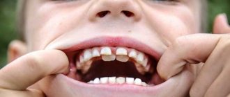Пустой зуб у ребенка — что делать маме?
