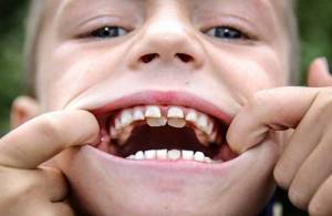 Пустой зуб у ребенка — что делать маме?