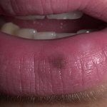 Пятна на губах доставляют эстетический дискомфорт