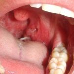 Рак горла: симптомы на ранних стадиях и первые признаки с фото