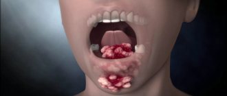 Рак языка: симптомы и лечение