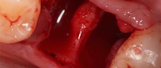 Разберемся, насколько долго обычно заживает десна после процедуры удаления зуба и как можно ускорить процесс ее заживления...