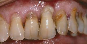 Развитие пародонтоза может привести к потере зубов