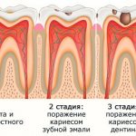 развитие пульпита