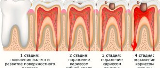 развитие пульпита