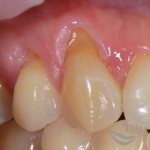 рецессия десны