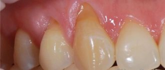 gum recession