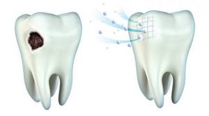 реминерализирующая терапия зубов