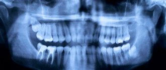 Рентген-снимок (запломбированные корни зуба).