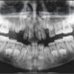 Рентгенографический снимок верхней и нижней челюсти