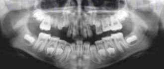 Рентгенографический снимок верхней и нижней челюсти