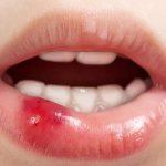 ретенционная киста на губе