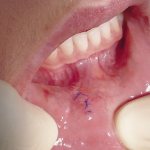 Резульатат лазерного удаления кисты на губе