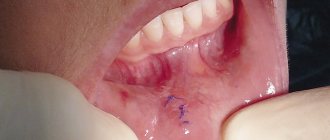 Резульатат лазерного удаления кисты на губе