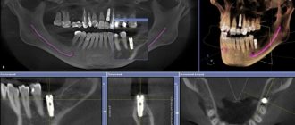 Результаты томографического обследования, 3d модель - стоматология Евродент