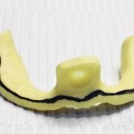 Rice. 1. An individual rigid tray for the lower jaw with an applied “stabilizing belt” border after appropriate trimming with a milling cutter and obtaining a vertical surface for contact with the mucous membrane of the cheeks and lower lip. 