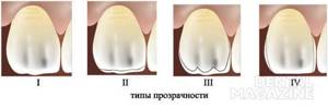 Рис. 1. Типы прозрачности эмали: 1 — зубы с прозрачным слоем по всей поверхности, 2 — с прозрачным слоем в области режущего края, 3 — с прозрачным слоем в области режущего края и проксимальных поверхностей, 4 — с прозрачным слоем только в области проксимальных поверхностей.