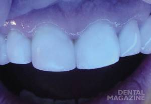 Рис. 18. При освещении резцов коротковолновым светом реставрации флуоресцируют так же, как твердые ткани зуба.