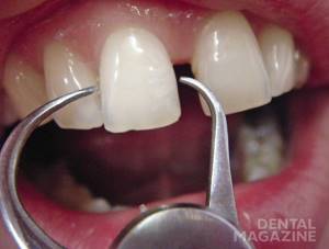 Рис. 4. Одонтометрия зубов.