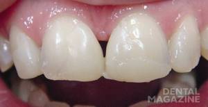 Рис. 5. Моделирование на зубах реставрации из «неходового» композита.
