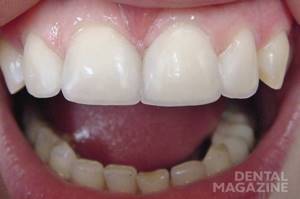 Рис. 8. Готовая работа: изменена форма зубов, устранены диастема и тремы, восстановлен режущий край, воссоздан тип прозрачности зубов.