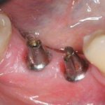 Само по себе хирургическое вмешательство при имплантации зуба может способствовать возникновению последующих болевых ощущений в десне.