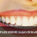 Самое распространенное заболевание зубов