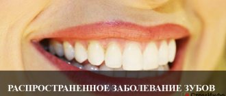 Самое распространенное заболевание зубов