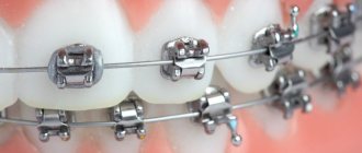 What are self-ligating braces?