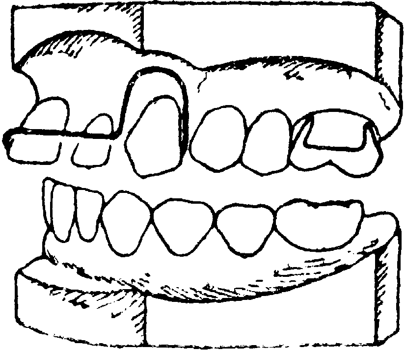 Изгиб зубов