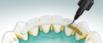 Splinting teeth