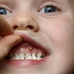 Симптомы и лечение энтеровирусного везикулярного стоматита