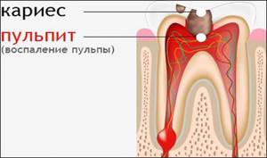 Симптомы пульпита и кариеса зуба мудрости. Лечить или удалять