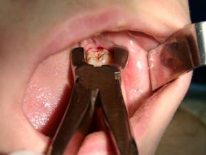 Симптомы пульпита и кариеса зуба мудрости. Лечить или удалять