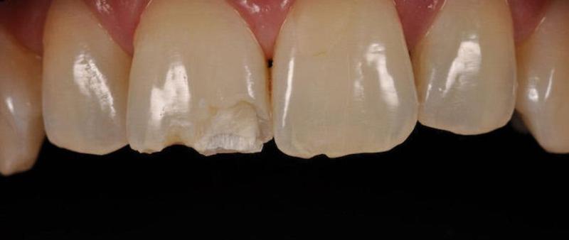 Скол зуба в результате травмы