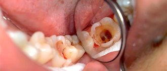 How many canals in teeth table