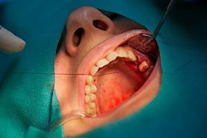 сколько служат импланты зубов отзывы